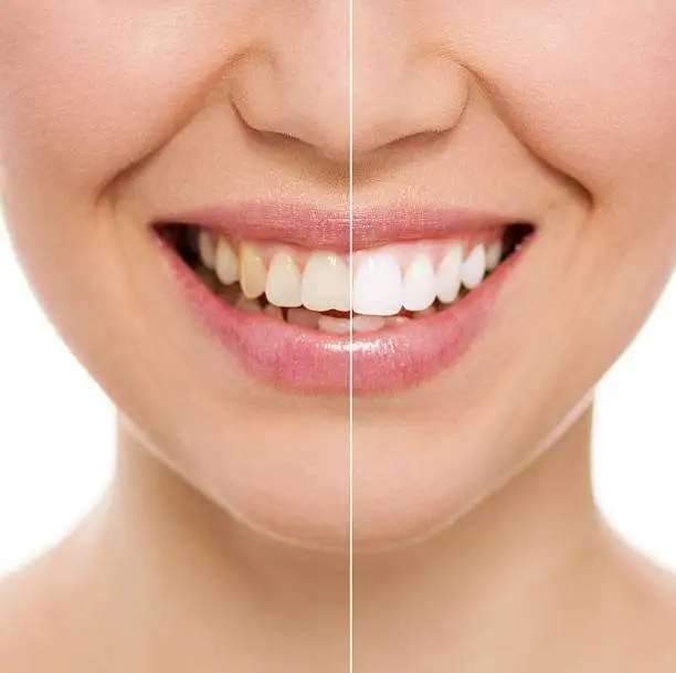 Teeth Whitening Chennai