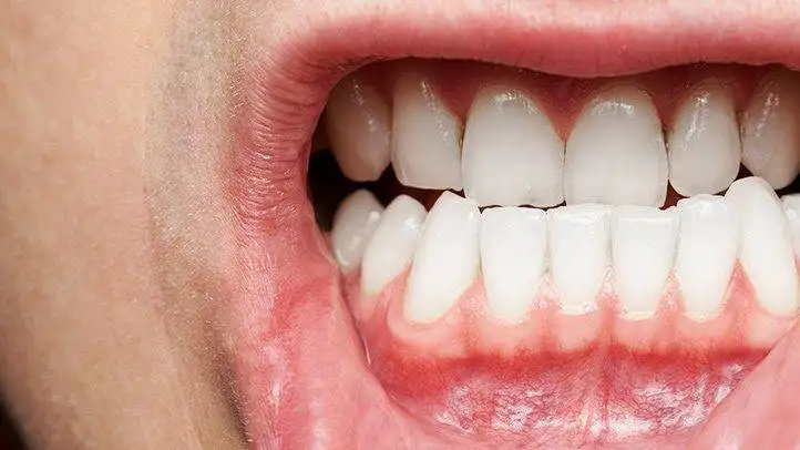 Expert Root Canal Treatment in Chennai