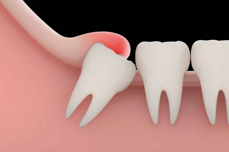 Affordable Dental Implants in Thoraipakkam