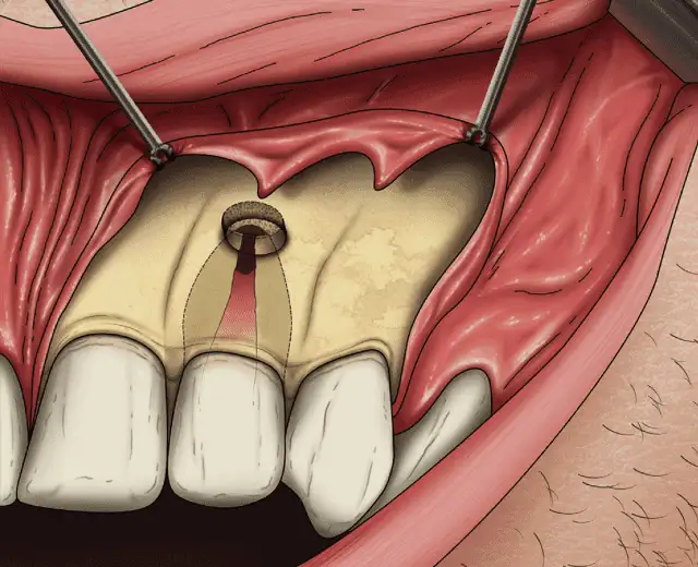 Painless Dental Procedures in Chennai