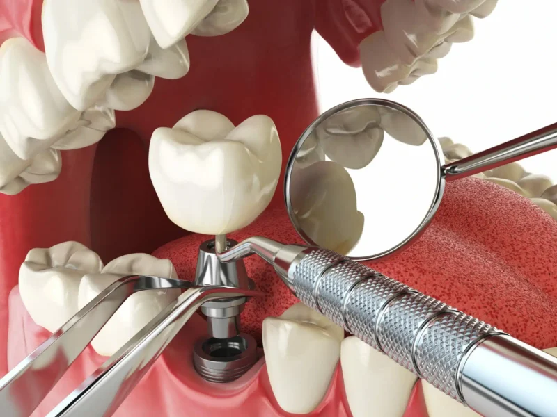 Affordable Dental Implants in Thoraipakkam