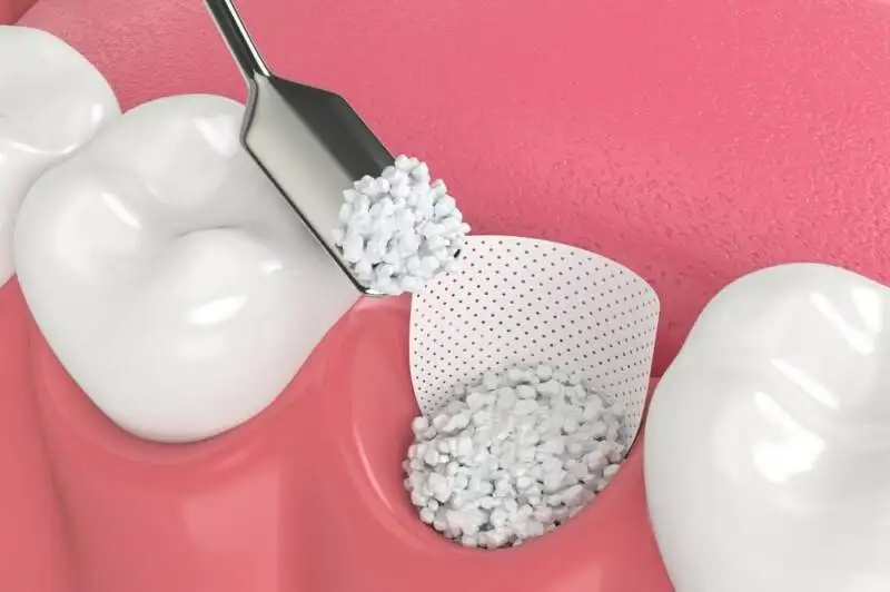 Affordable Dental Implants in Thoraipakkam