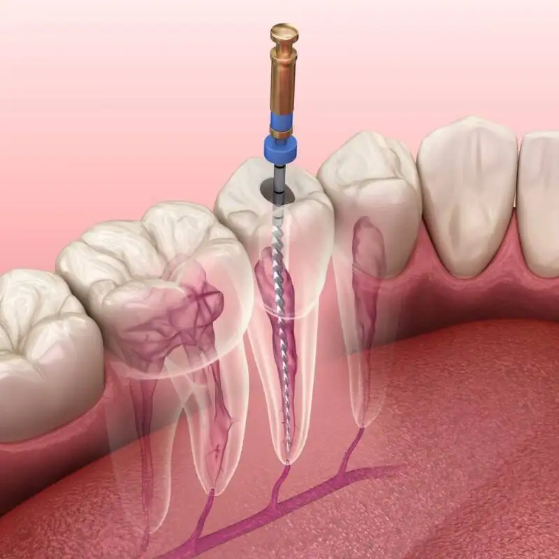 Painless Dental Procedures in Chennai