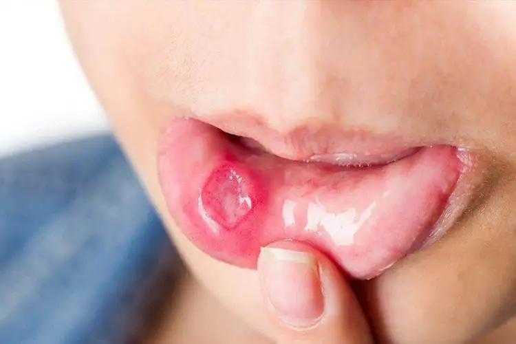 Expert Root Canal Treatment in Chennai