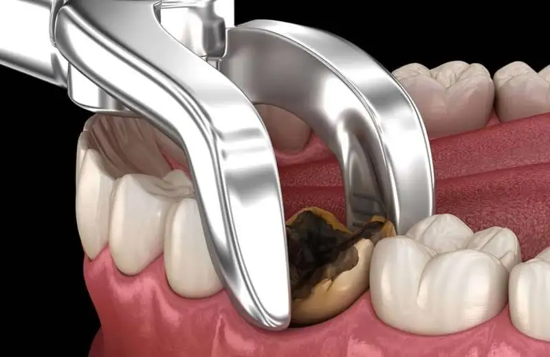 Affordable Dental Implants in Thoraipakkam