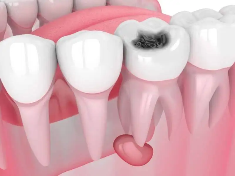Painless Dental Procedures in Chennai