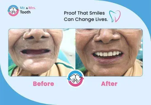 Teeth Whitening Chennai