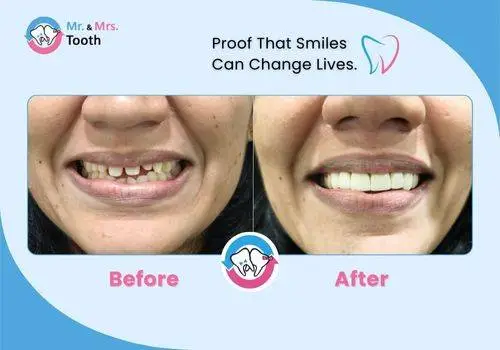 Teeth Whitening Chennai