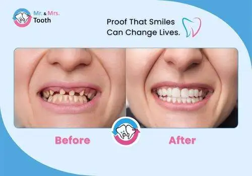 Teeth Whitening Chennai