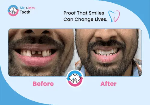 Teeth Whitening Chennai