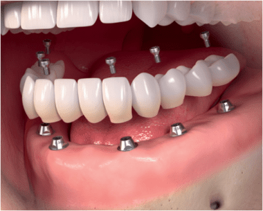 Family Dental Clinic in Chennai