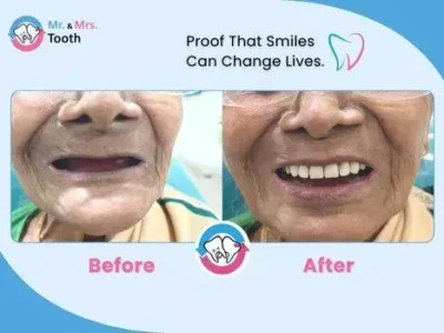 Teeth Whitening Chennai