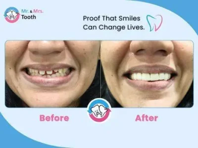 Teeth Whitening Chennai