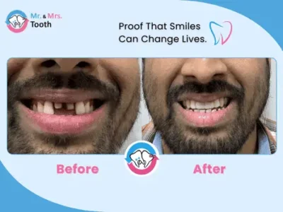 Teeth Whitening Chennai