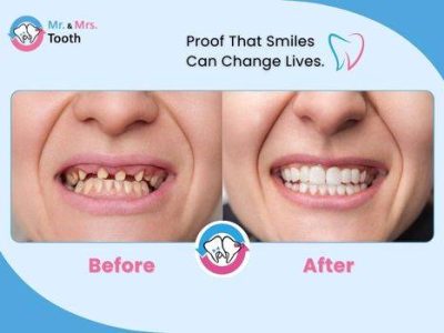 Teeth Whitening Chennai